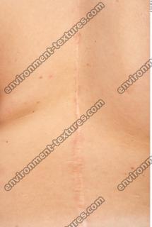human skin scar 0005